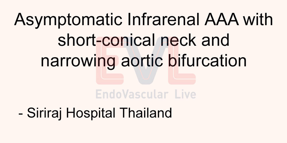 Asymptomatic Infrarenal AAA with short-conical neck and narrowing aortic bifurcation