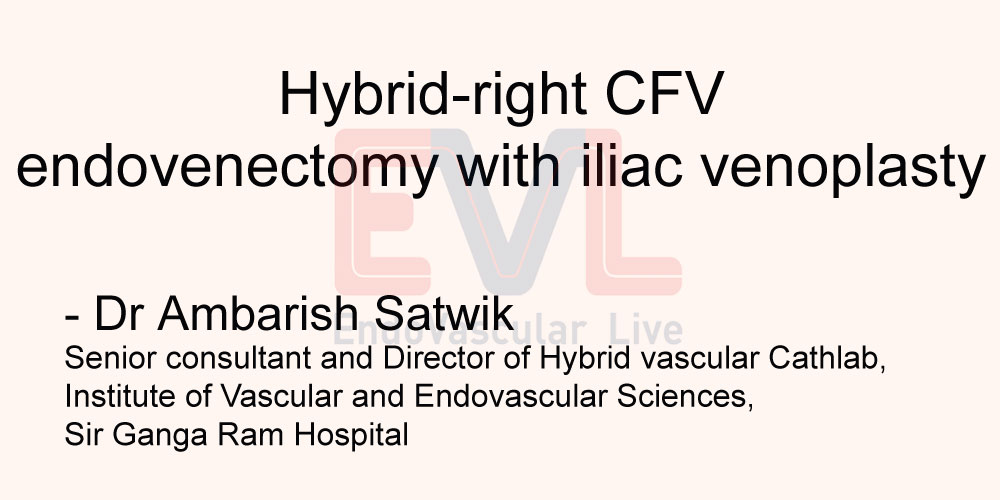 Hybrid right CFV endovenectomy with iliac venoplasty