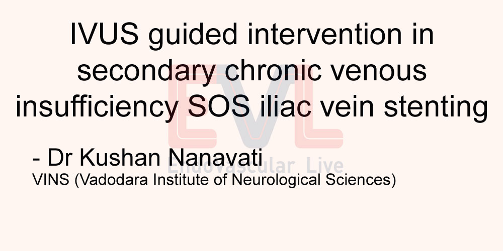 IVUS guided intervention in secondary chronic venous insufficiency SOS iliac vein stenting