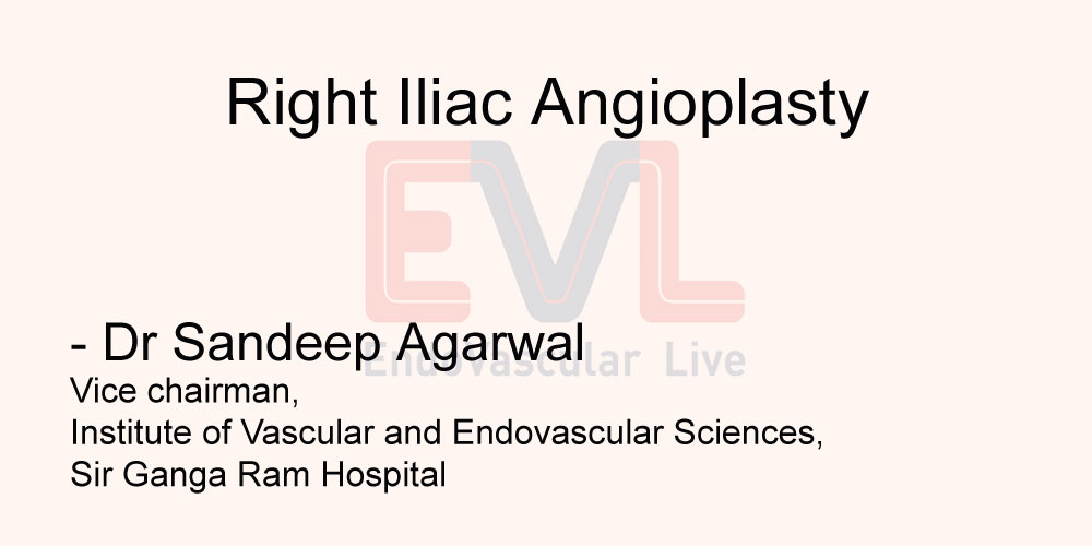 Right Iliac Angioplasty